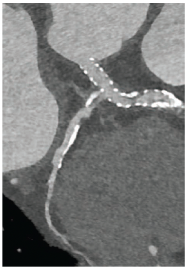 Figure 2. Circumflex artery (Cx) CPR with portion of LAD.