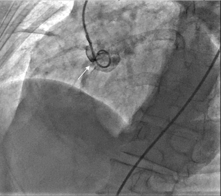 Figure 1. An aortogram revealing a communication between the right atrium and the non-coronary sinus of Valsalva (white arrow).