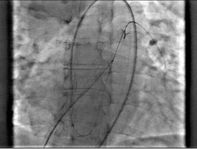 Figure 2A. Snaring of the wire.