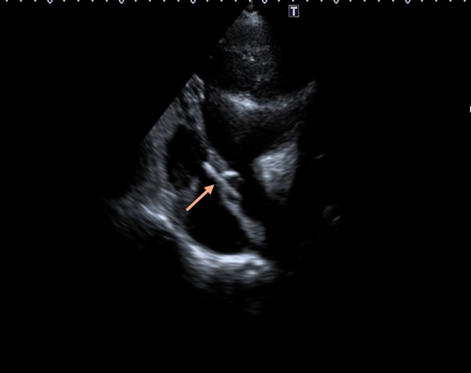 Figure 2B. Catheter advanced across the defect (orange arrow) on transthoracic echocardiography.