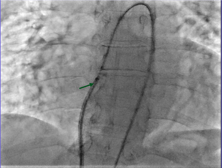 Figure 3. Advancement of a 7 French (F) sheath (green arrow) across the arteriovenous (AV) rail.