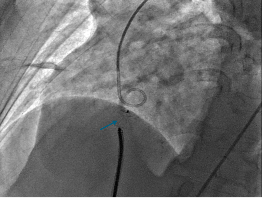 Figure 4A. Positioning of the Amplatzer Duct Occluder (ADO) device (Abbott) (blue arrow). 