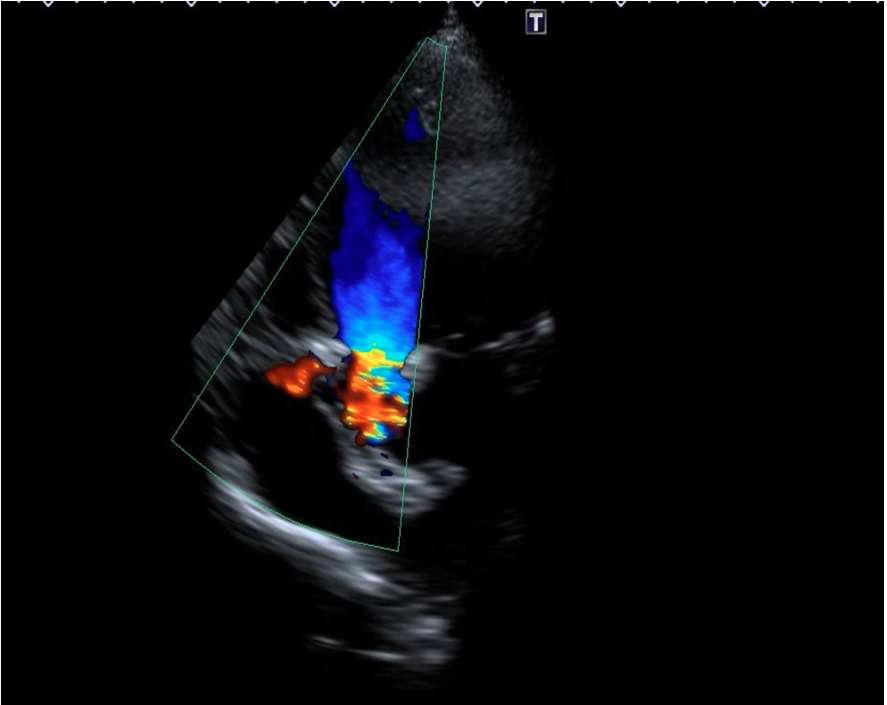 Figure 4C. No residual shunt observed across the defect following device placement on transthoracic echocardiography.
