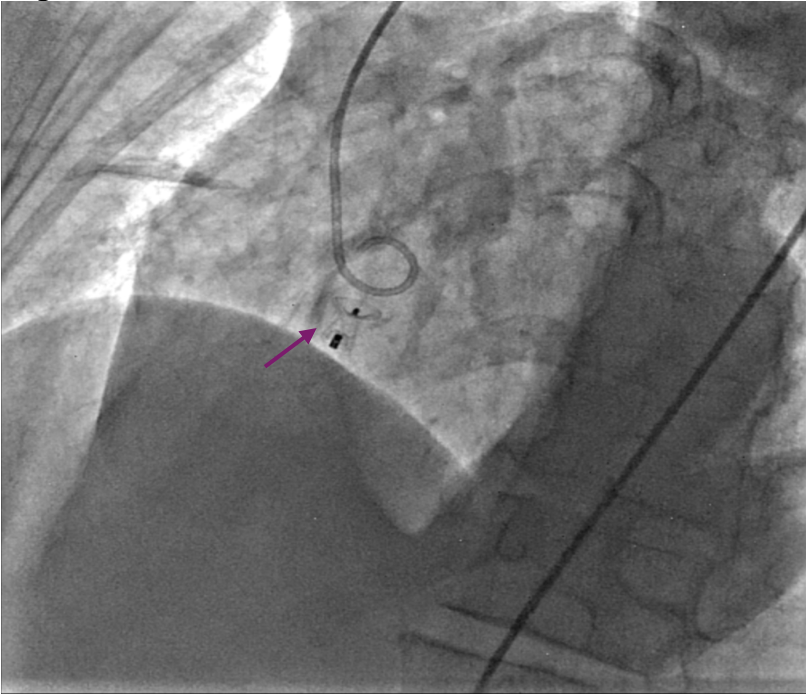 Figure 5A. Device deployed (purple arrow). 