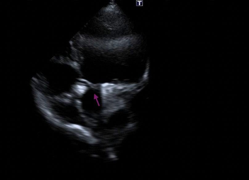 Figure 5B Transthoracic echocardiography.
