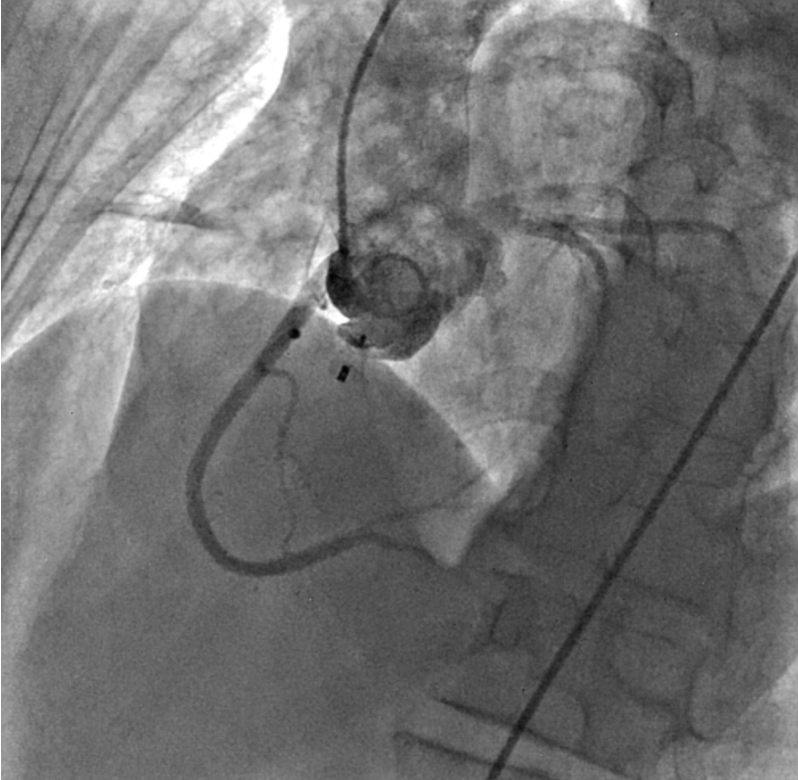 Figure 6. (A-B) Check injections demonstrating a well-seated device with no encroachment on the coronary arteries and absence of tricuspid regurgitation.