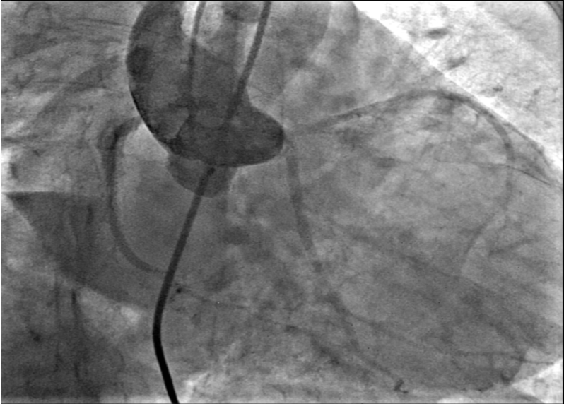 Figure 6. (A-B) Check injections demonstrating a well-seated device with no encroachment on the coronary arteries and absence of tricuspid regurgitation.