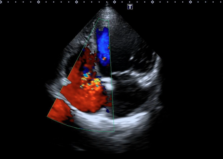 Figure 7. (A-B) After device placement, no progression of tricuspid regurgitation was noted on transthoracic echocardiography.