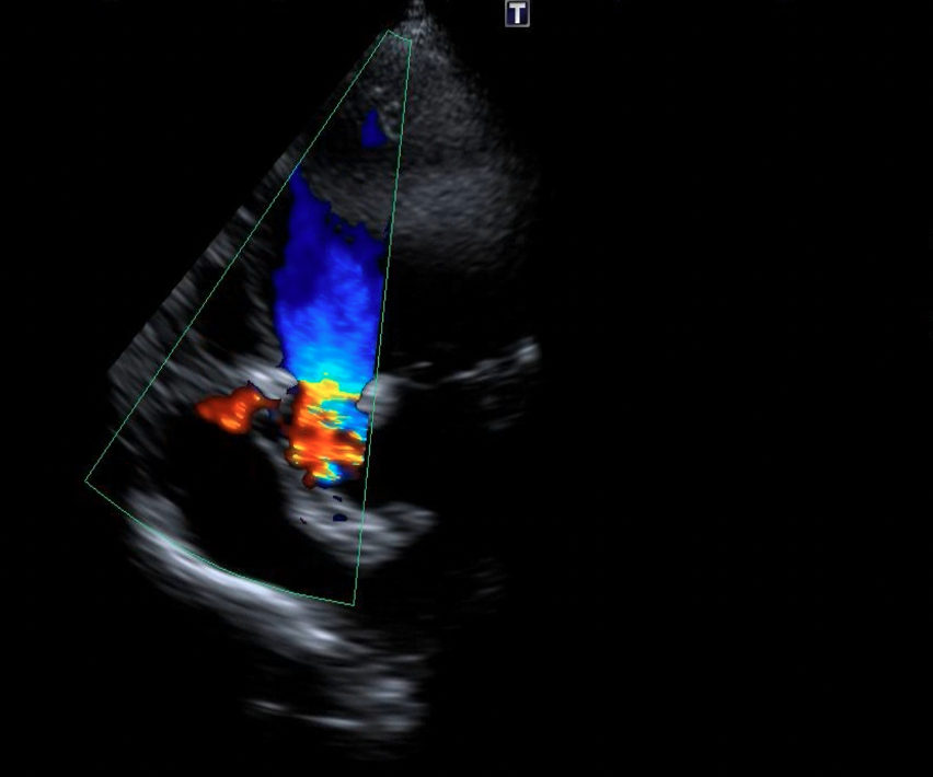 Figure 7. (A-B) After device placement, no progression of tricuspid regurgitation was noted on transthoracic echocardiography.