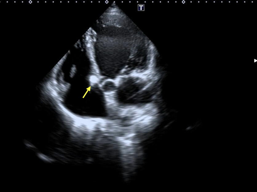 Figure 8. (A-B) Follow-up transthoracic echocardiography demonstrated satisfactory device seating (yellow arrow), and stable mitral and tricuspid valve function without increased regurgitation.