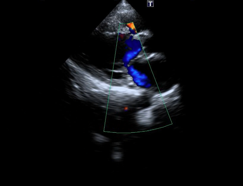 Figure 8. (A-B) Follow-up transthoracic echocardiography demonstrated satisfactory device seating (yellow arrow), and stable mitral and tricuspid valve function without increased regurgitation.