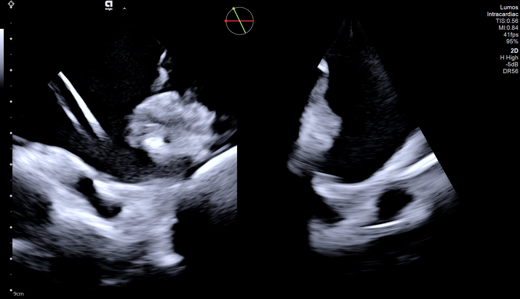 Figure 2. ICE imaging for transeptal sheath navigation.