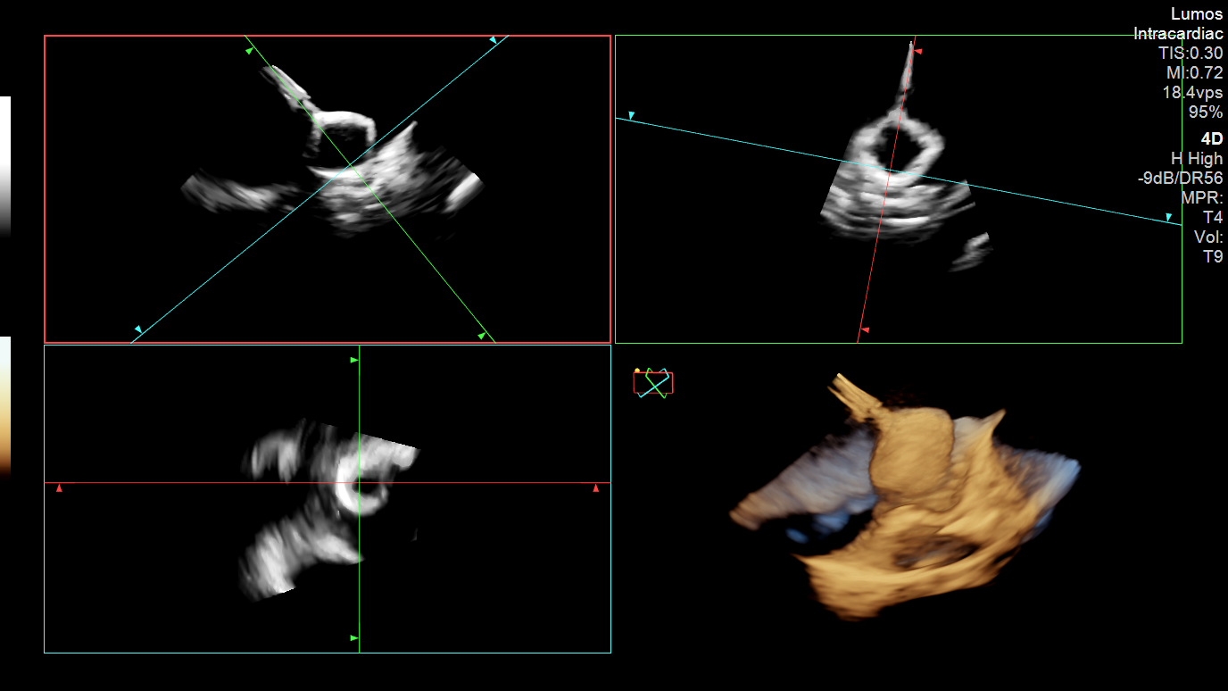 Figure 3. LAAO device orientation prior to tension/tug test.