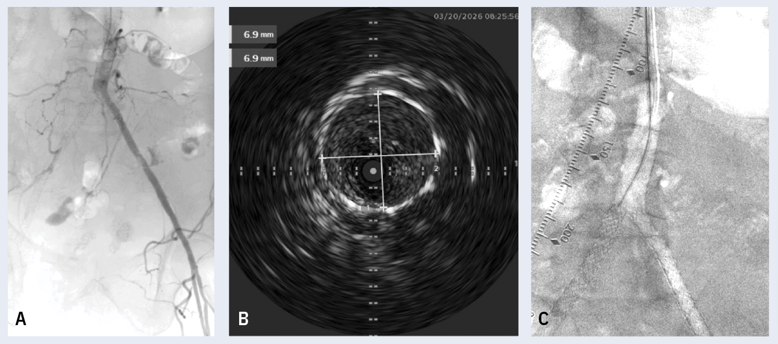 Figure. (A) Pre-procedure chronic total occlusion, right external iliac arteries. (B) Peri-procedure intravascular ultrasound.  (C) Occluded stents.