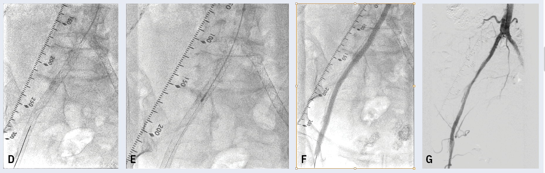 (D) Successful crossing with the guidewire. (E) Mechanical thrombectomy using the Rotarex™ Catheter System. (F) Percutaneous transluminal angioplasty using a drug-coated balloon. (G) Final results.