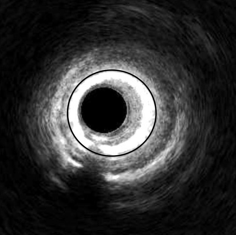 Figure 1. Intravascular ultrasound (IVUS) imaging of a left anterior descending artery showing in-stent restenosis (black circle). 