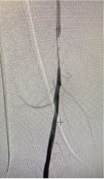 Figure 1. Severe in-stent restenosis. 