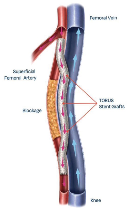 Figure 2. Percutaneous transmural arterial bypass (PTAB) (DETOUR System, Endologix). Courtesy Endologix.