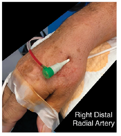 CLD Casazza Right Distal Radial Artery Access