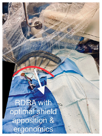 CLD Casazza Figure 2 Right Distal Radial Artery Access