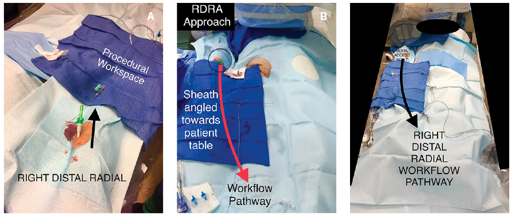 CLD Casazza Figure 3A-C Right Distal Radial Artery Access