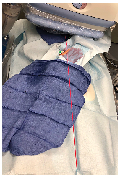 CLD Casazza Figure 4 Right Distal Radial Artery Access