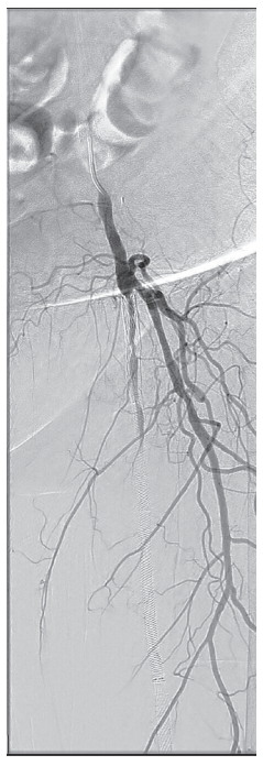 CLD-Endologix-Fig1.png 