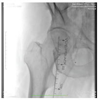 CLD-Endologix-Fig10.png 