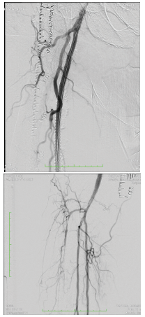 CLD-Endologix-Fig11-12.png 