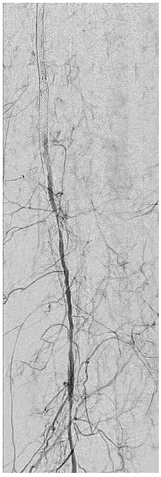 CLD-Endologix-Fig2.png 