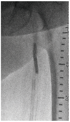 CLD-Endologix-Fig3.png 