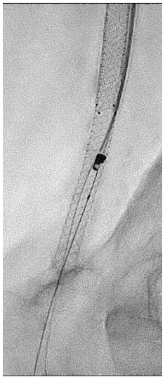 CLD-Endologix-Fig4.png 