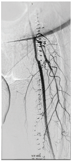 CLD-Endologix-Fig6.png 