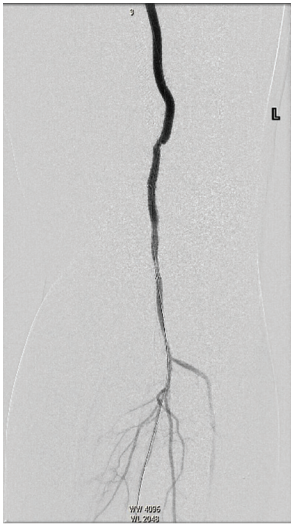 CLD-Endologix-Fig7.png 