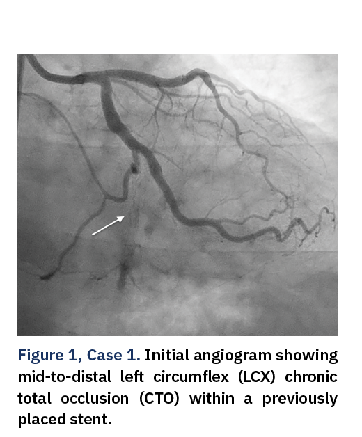 Figure 1, Case 1. Initial angiogram showing mid-to-distal left circumflex (LCX) chronic total occlusion (CTO) within a previously placed stent.