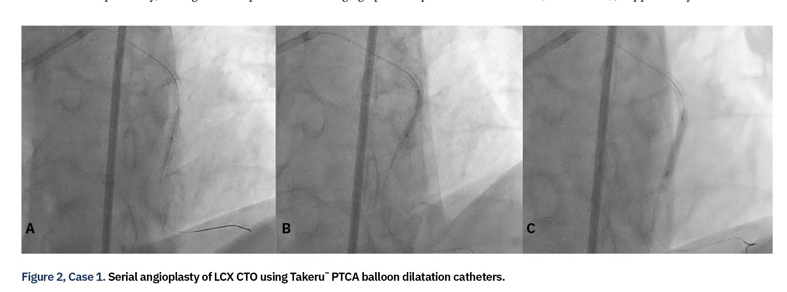 Figure 2, Case 1. Serial angioplasty of LCX CTO using Takeru™ PTCA balloon dilatation catheters.