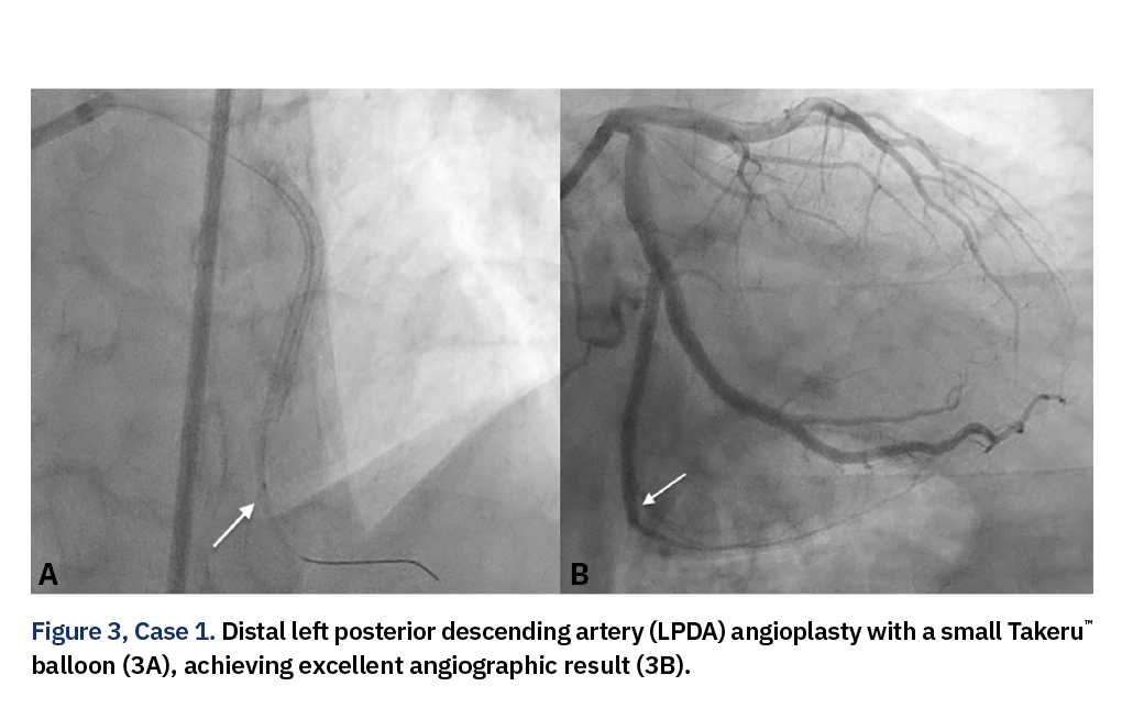 Figure 3, Case 1. Distal left posterior descending artery (LPDA) angioplasty with a small Takeru™ balloon (3A), achieving excellent angiographic result (3B).