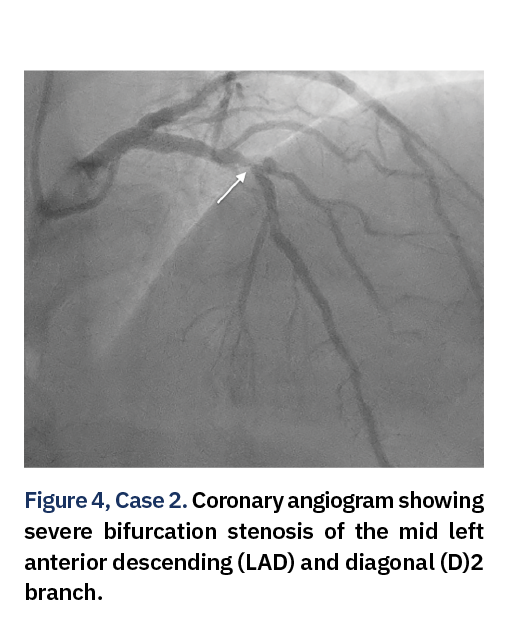 Figure 4, Case 2. Coronary angiogram showing severe bifurcation stenosis of the mid left anterior descending (LAD) and diagonal (D)2 branch.