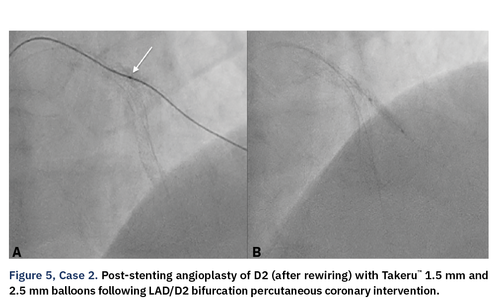 Figure 5, Case 2. Post-stenting angioplasty of D2 (after rewiring) with Takeru™ 1.5 mm and 2.5 mm balloons following LAD/D2 bifurcation percutaneous coronary intervention.