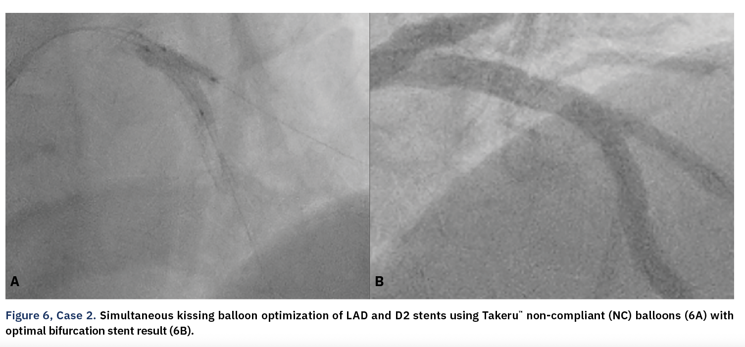 Figure 6, Case 2. Simultaneous kissing balloon optimization of LAD and D2 stents using Takeru™ non-compliant (NC) balloons (6A) with optimal bifurcation stent result (6B).