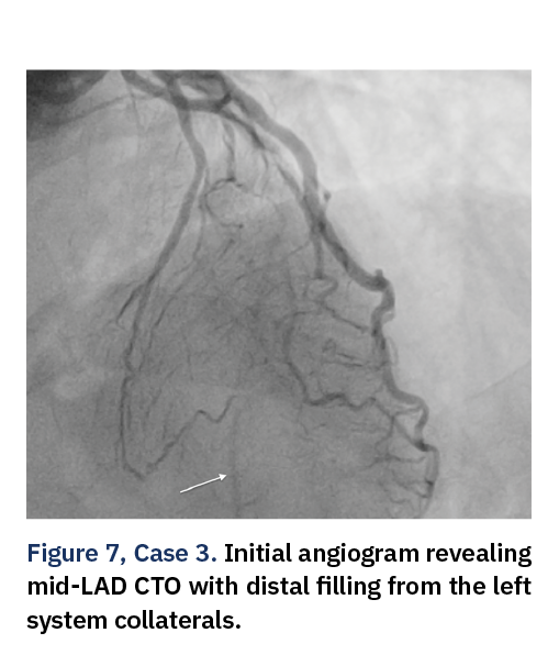 Figure 7, Case 3. Initial angiogram revealing mid-LAD CTO with distal filling from the left system collaterals.