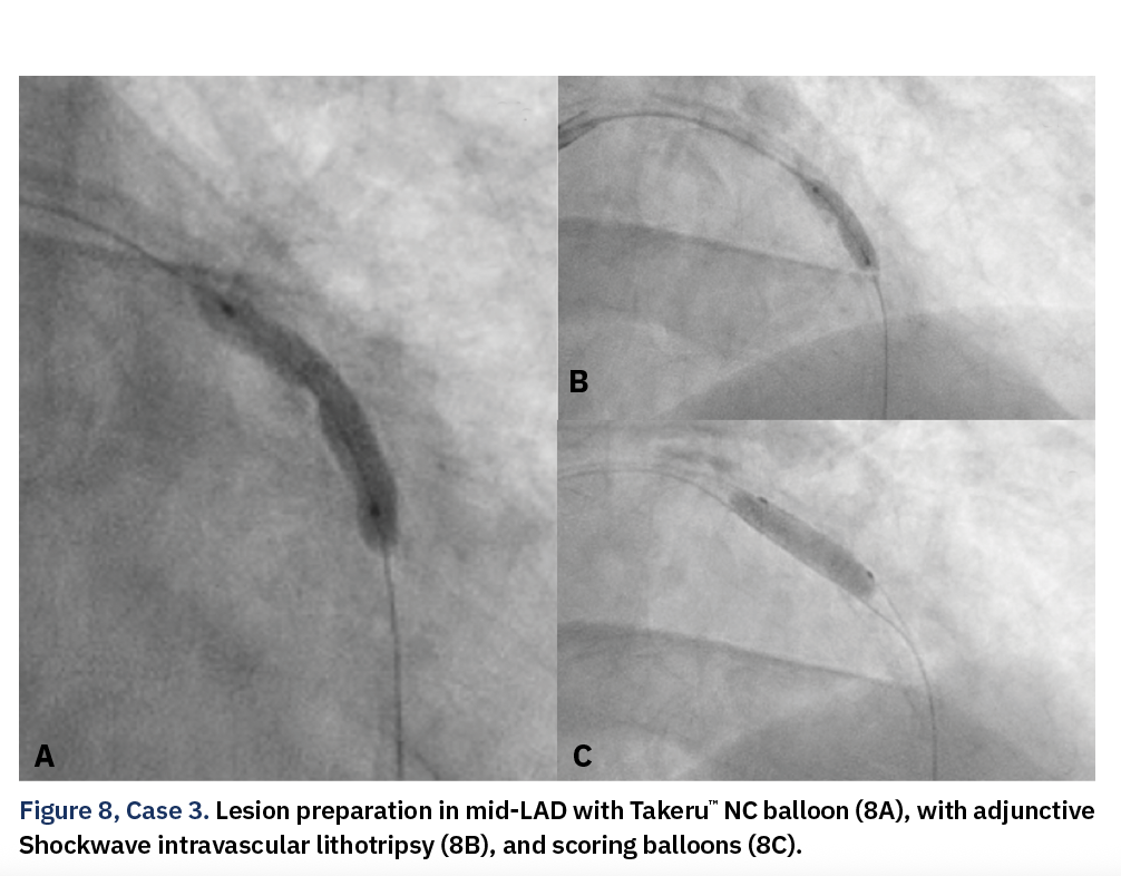 Figure 8, Case 3. Lesion preparation in mid-LAD with Takeru™ NC balloon (8A), with adjunctive Shockwave intravascular lithotripsy (8B), and scoring balloons (8C).