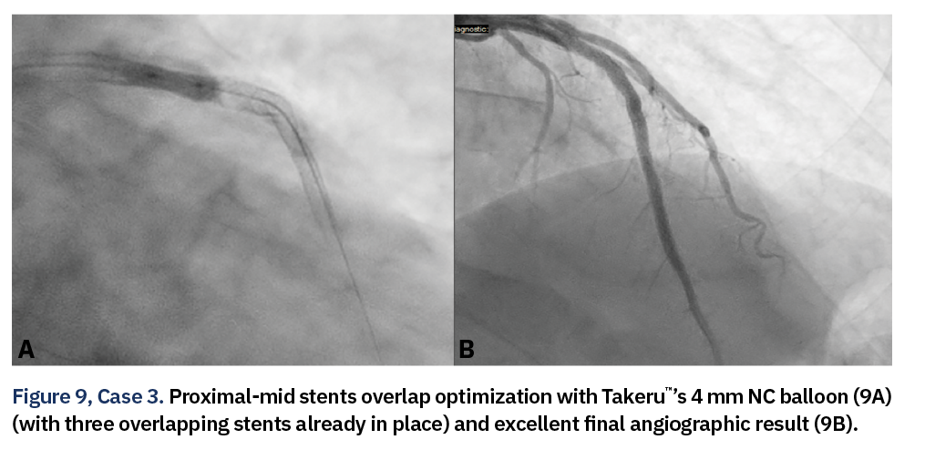 Figure 9, Case 3. Proximal-mid stents overlap optimization with Takeru™’s 4 mm NC balloon (9A) (with three overlapping stents already in place) and excellent final angiographic result (9B).