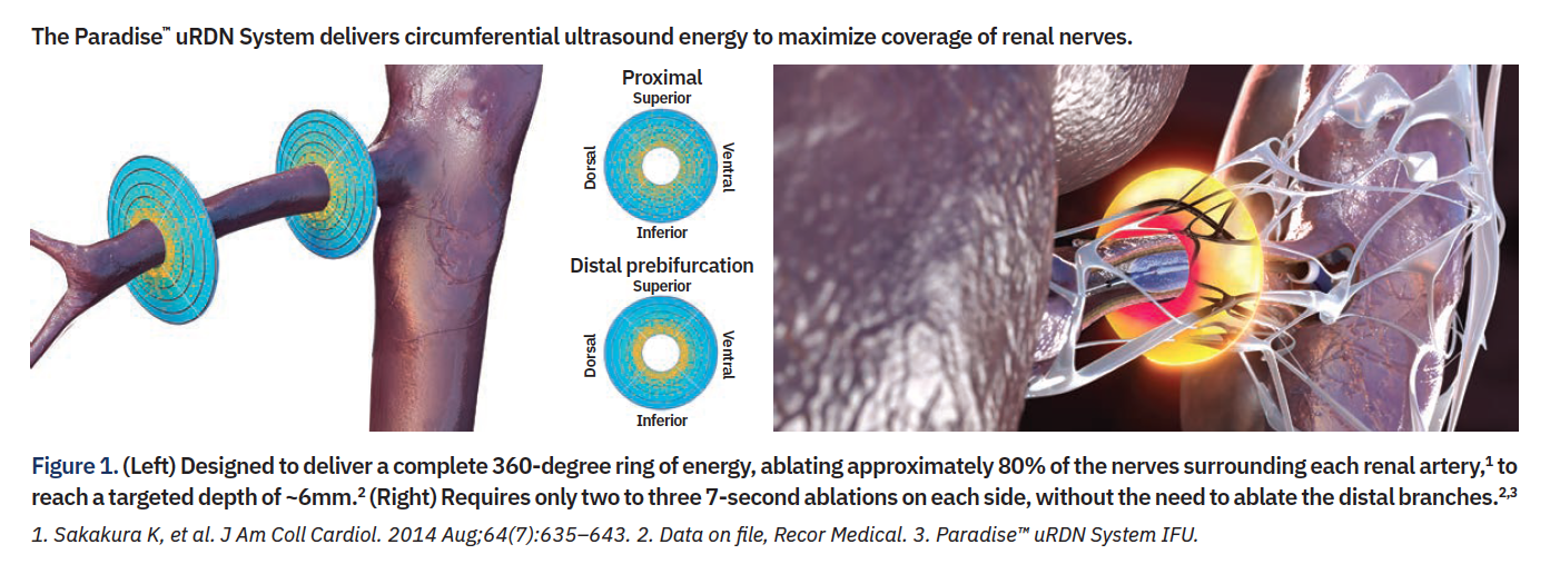 The Paradise™ uRDN System delivers circumferential ultrasound energy to maximize coverage of renal nerves.
