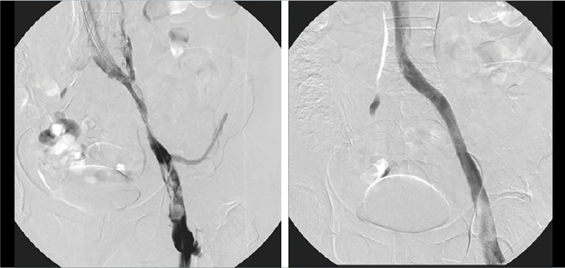 CLD Lichtenberg Aspirex Figure