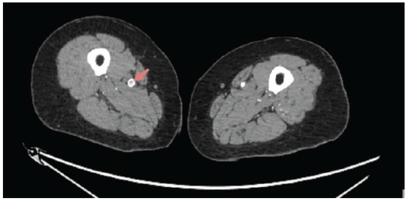 Figure 1. Computed tomography angiography (CTA) aorta run-off showing a stent (red arrow) in the right superficial femoral artery (SFA) with severe in-stent stenosis, and multifocal narrowing throughout, including the near complete occlusion over a 2.2 cm long segment of the proximal left SFA, the right peroneal artery, and right tibio-peroneal and posterior tibial arteries. 