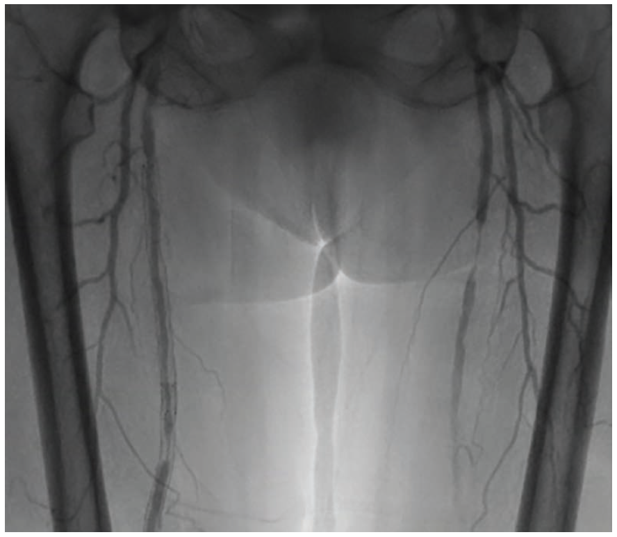 Figure 2. Preintervention. Severe multifocal narrowing, with very faint runoff in the tibial at the left.