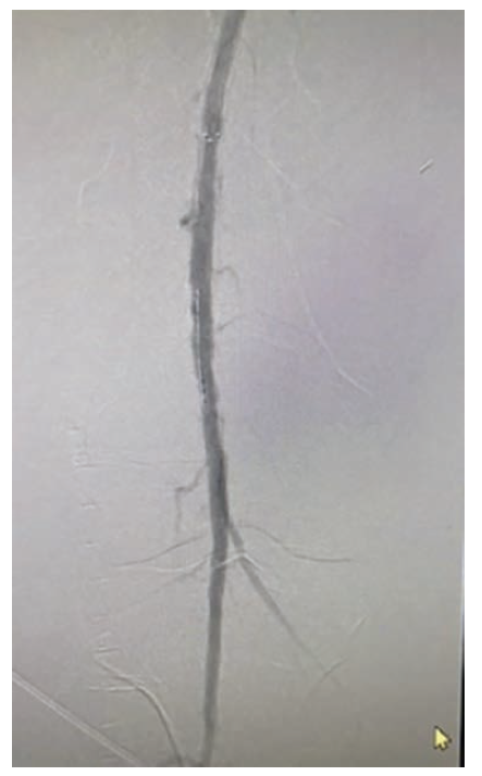 Figure 3. A post-intervention left-sided angiogram showing excellent results with TIMI-3 flow. 