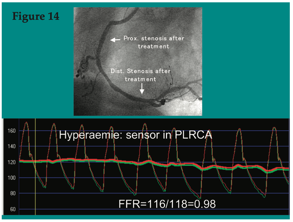 CLD Pijls Figure 14