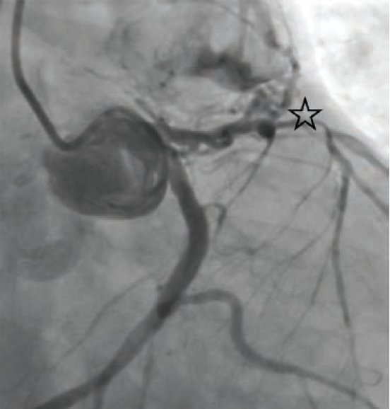 Figure 1, Case 1. Left anterior descending (LAD) to pulmonary artery (PA) fistula (junction, star), obtained under fluoroscopy during left heart catheterization.